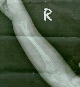 newbone